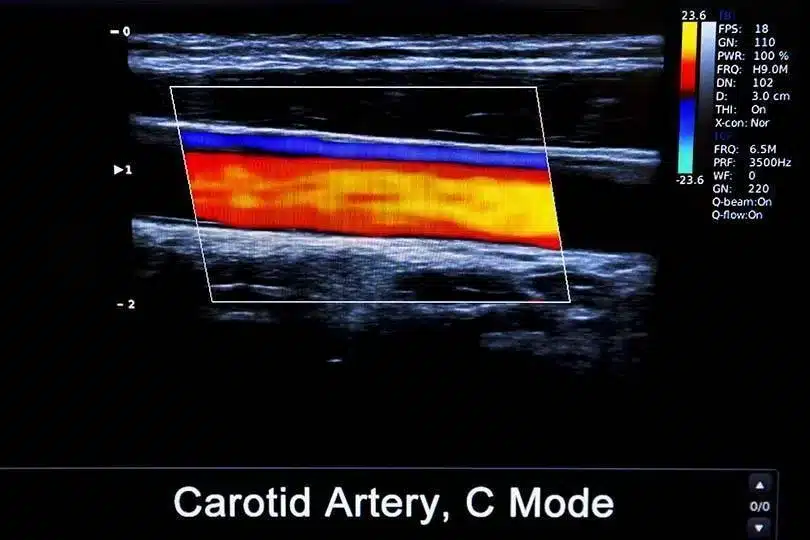 Ultrasound Scan Colour Doppler Duplex And Triplex Doppler What Do 