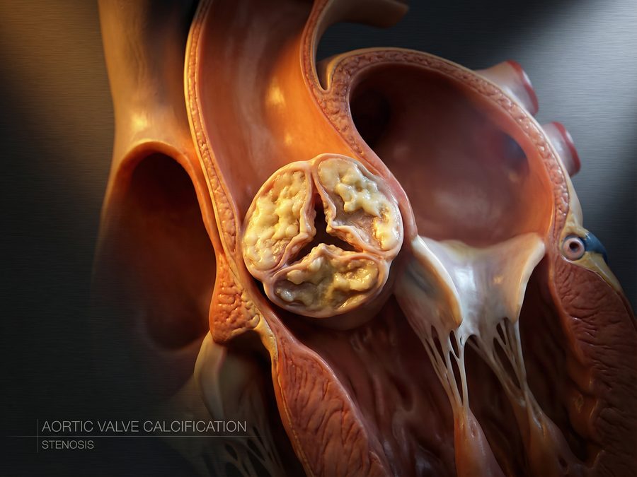 Medical illustration showing a calcified and narrowed aortic valve